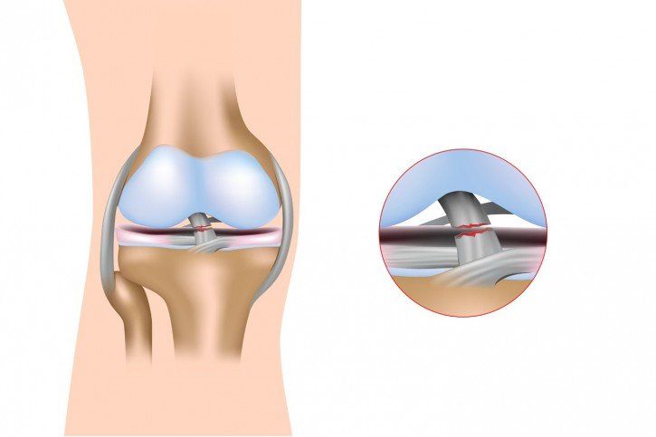 Rehabilitacja po rekonstrukcji  więzadła krzyżowego ACL - krok po kroku 