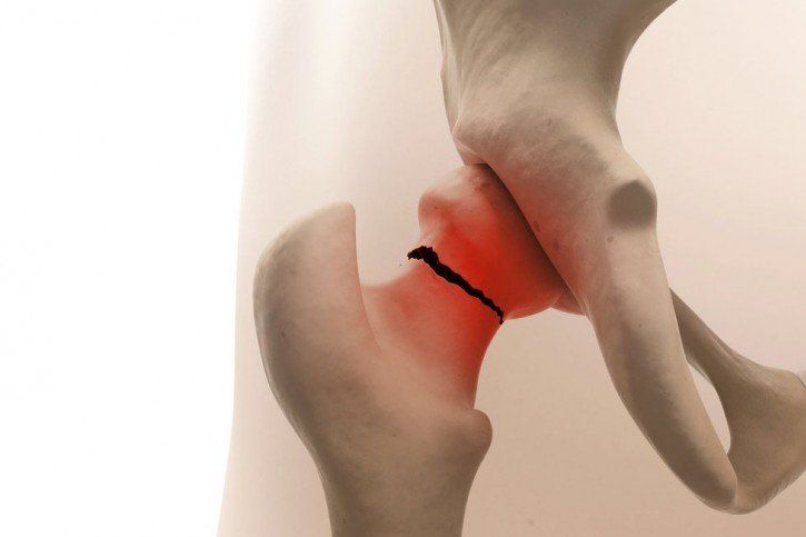 Rehabilitacja po złamaniu szyjki kości udowej - krok po kroku 